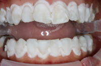 オフィスホワイトニング1