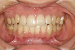 矯正後のケアについて術前