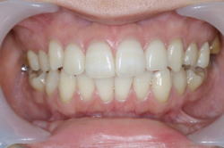 矯正後のケアについて術後