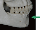 矯正治療の解剖学的限界1