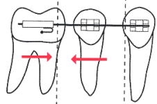 矯正治療のメカニクス的限界1