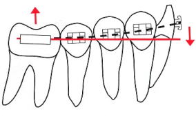 矯正治療のメカニクス的限界2