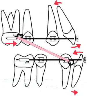 矯正治療のメカニクス的限界3