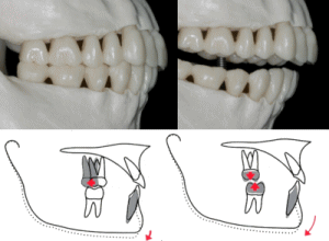 矯正治療の解剖学的限界8