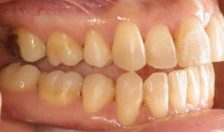 矯正歯科治療により理想的に噛ませた症例7