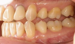 矯正歯科治療により理想的に噛ませた症例8