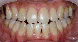 噛んでそうだが噛んでいない症例1