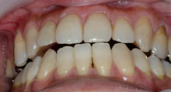 噛んでそうだが噛んでいない症例2