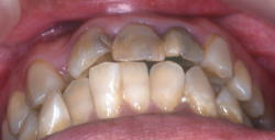 矯正歯科治療により理想的に噛ませた症例1