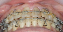 矯正歯科治療により理想的に噛ませた症例2
