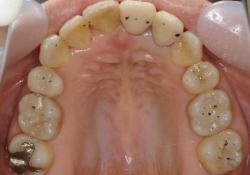 矯正歯科治療により理想的に噛ませた症例3