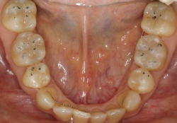 矯正歯科治療により理想的に噛ませた症例4