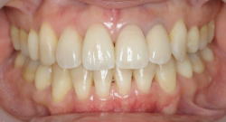 矯正歯科治療により理想的に噛ませた症例5