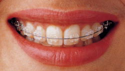 ワイヤーを使った矯正歯科治療　セラミックブラケット