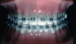 歯並び矯正歯科（歯列矯正）大阪 梅田 かわさと歯科 矯正歯科　ワイヤーを使った矯正歯科治療　メタルブラケット