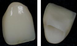 セラミックを被せるクイック矯正1