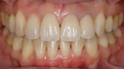 矯正装置の見え具合9