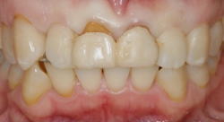 矯正装置の見え具合1