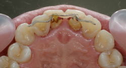 矯正装置の見え具合2