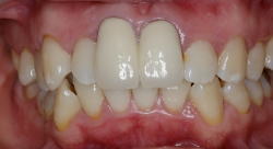 矯正装置の見え具合3