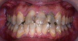 矯正装置の見え具合5