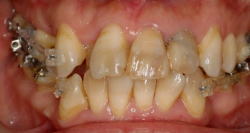 矯正装置の見え具合6