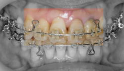 矯正装置の見え具合8