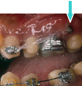 ミニインプラント2