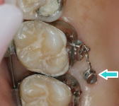 ミニインプラント3