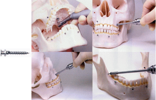 ミニインプラント5