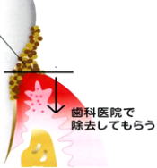 ポケット内洗浄1