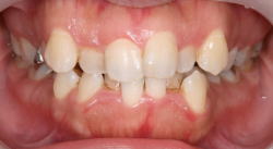 Ⅰ級叢生（乱杭歯、八重歯）