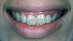 ガミースマイル