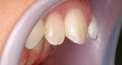 Ⅱ級（上顎前突・でっ歯）