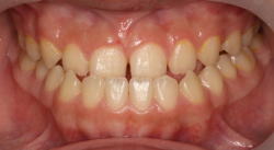 Ⅲ級（下顎前突・反対咬合・うけ口）