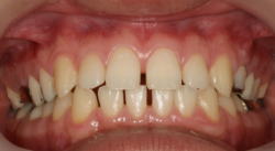 空隙歯列弓（すきっ歯）