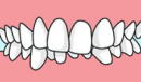 過蓋咬合　図解