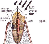 歯ぎしり　くいしばりがある1