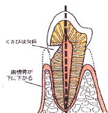 歯ぎしり　くいしばりがある2